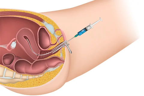 illustration of intrauterine insemination procedure with a syringe and catheter in the uterus.
