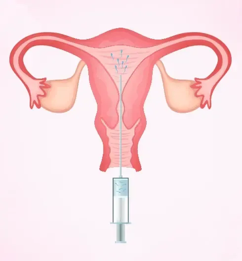 Illustration of a uterus with a syringe indicating an intrauterine insemination procedure.