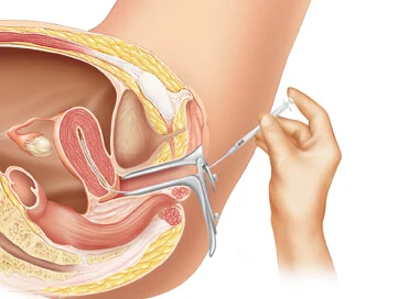 illustration of intrauterine insemination procedure with a hand holding a speculum and syringe near the uterus