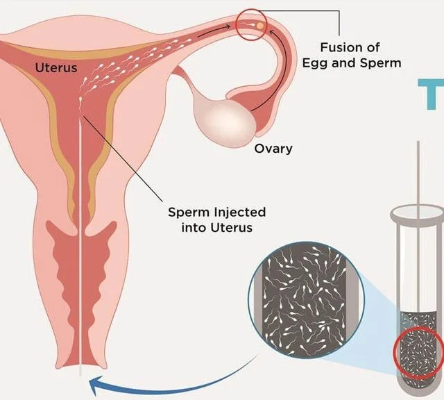 Diagram illustrating the IUI process, showing sperm injection into the uterus and egg fertilization.