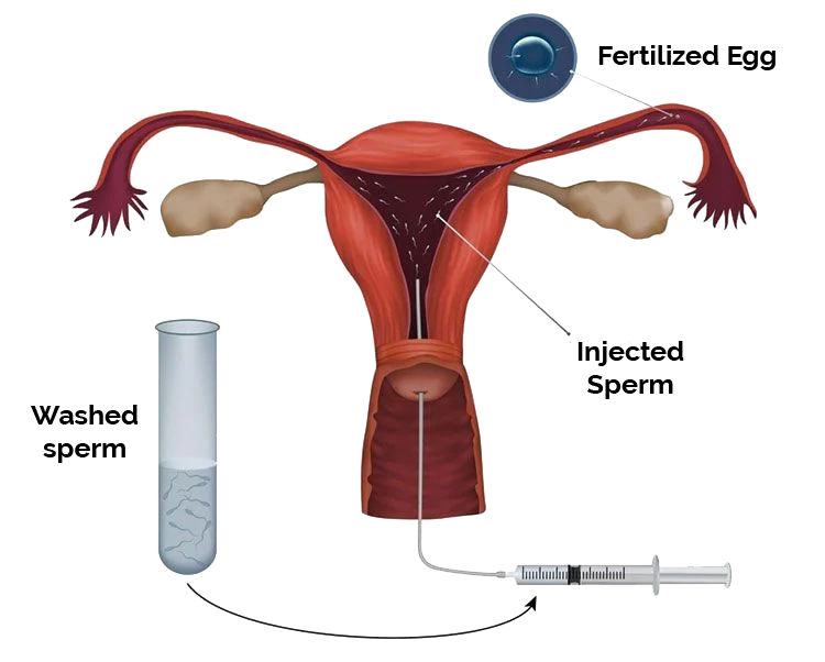 diagram of the female reproductive system with an IUI syringe and test tube for artificial insemination