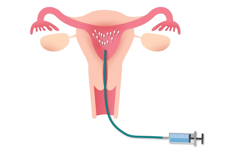 diagram of a uterus with a syringe for intrauterine insemination procedure
