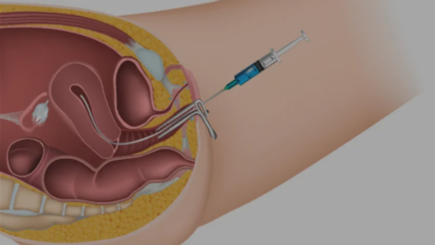 Illustration of intrauterine insemination (IUI) procedure with syringe and catheter in the uterus.