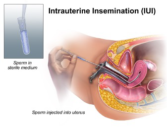 Illustration of intrauterine insemination (IUI) procedure, showing sperm injection into the uterus.