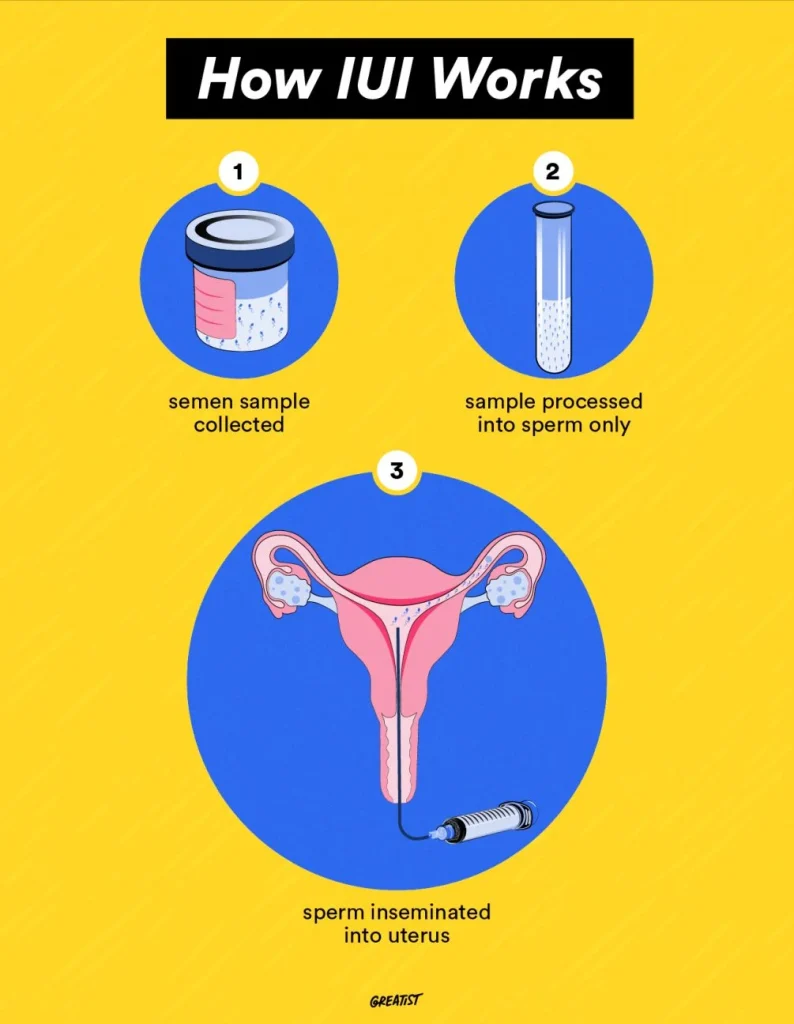 illustration explaining the steps of intrauterine insemination (IUI) process on a bright yellow background