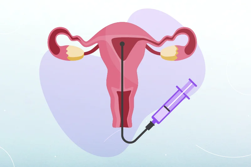 Illustration of the uterus with a syringe, depicting the intrauterine insemination procedure.