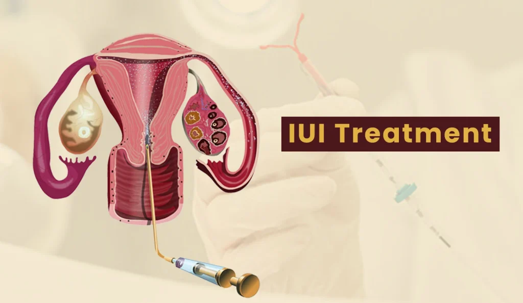 illustration of the uterus and ovaries with a syringe, labeled "IUI Treatment" in the background