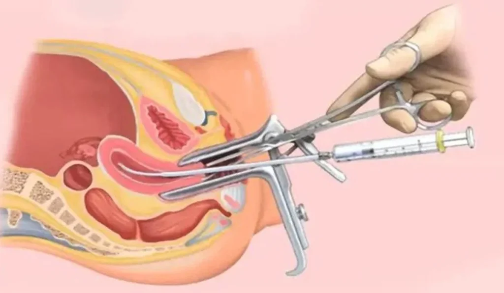 illustration of an intrauterine insemination procedure with medical instruments and anatomical details