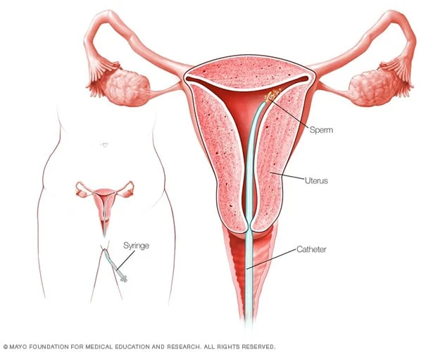 diagram illustrating intrauterine insemination (IUI) procedure with uterus, sperm, and catheter labeled