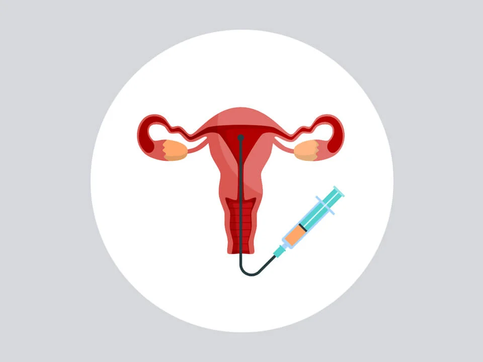 Illustration of a uterus with a syringe, representing intrauterine insemination (IUI) procedure.