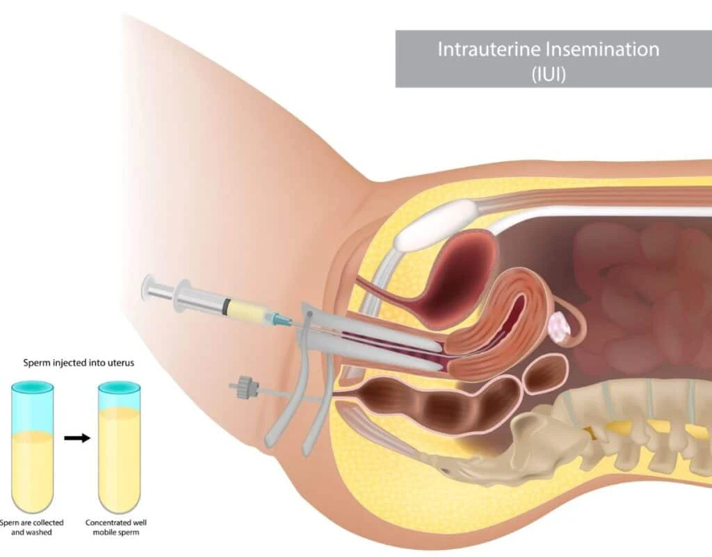 Diagram illustrating intrauterine insemination (IUI) procedure with sperm injection into the uterus.