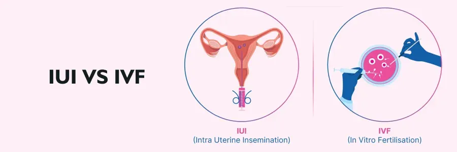 Comparison of IUI and IVF with illustrations of each procedure.
