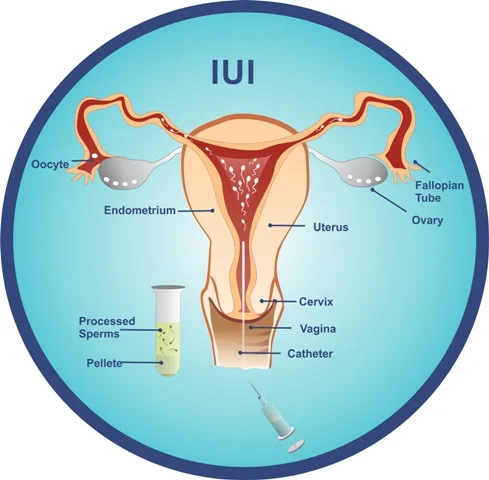 diagram illustrating intrauterine insemination (IUI) with labeled reproductive anatomy and procedures