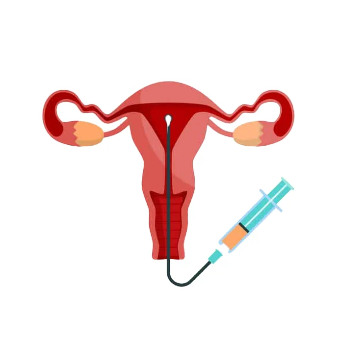 illustration of a uterus with a syringe for intrauterine insemination (IUI) procedure
