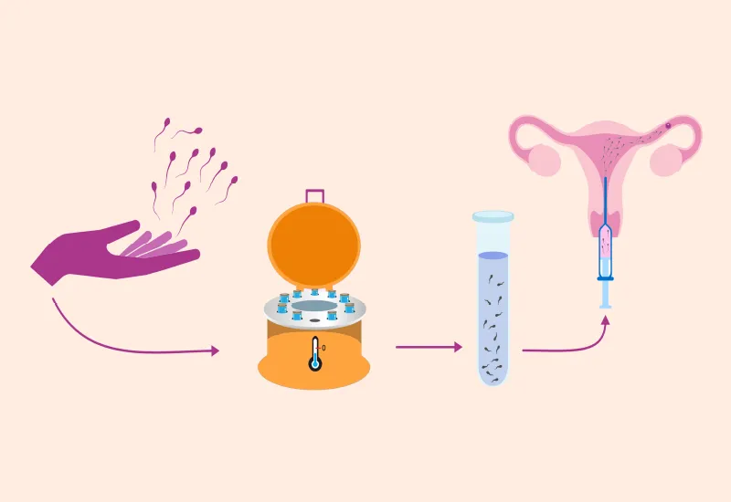 illustration of the IUI process, showing sperm collection, preparation, and insertion into the uterus