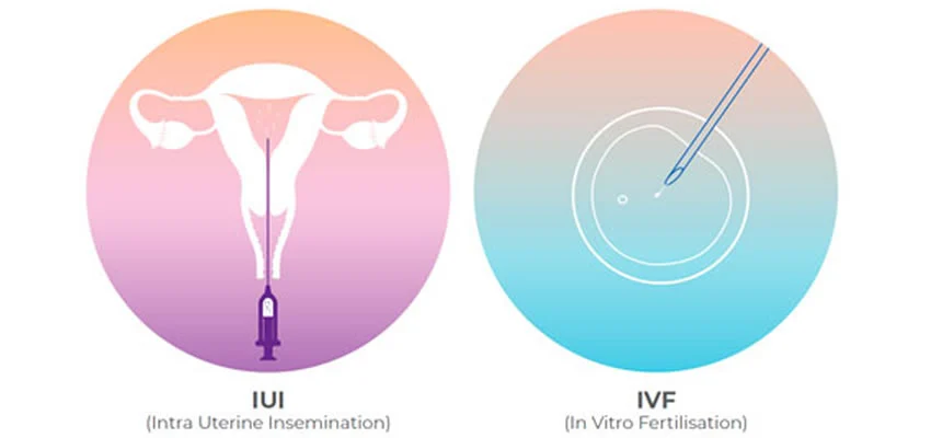 comparison of IUI and IVF procedures illustrated with simple graphics and labels