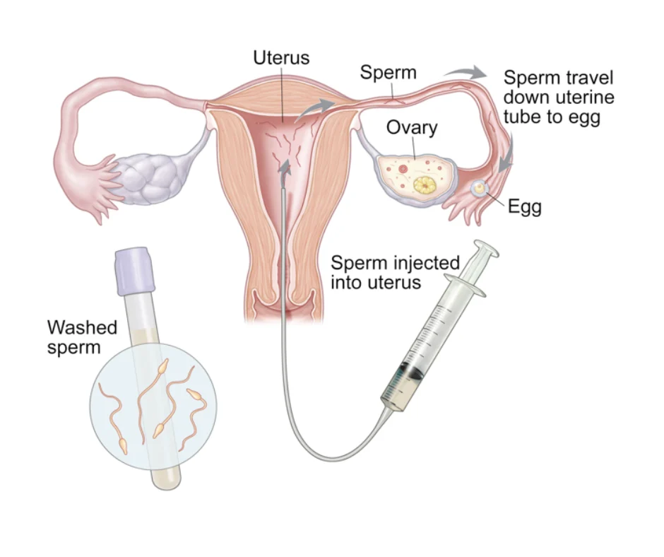 diagram illustrating intrauterine insemination process, showing sperm injection into the uterus and egg fertilization pathway