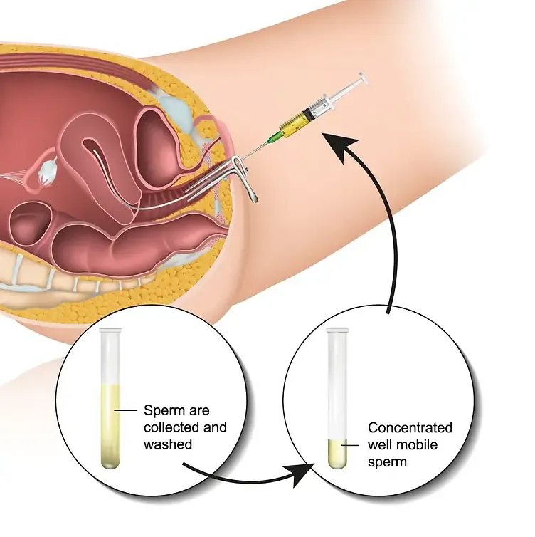 Illustration of intrauterine insemination process, showing sperm collection and injection into the uterus.